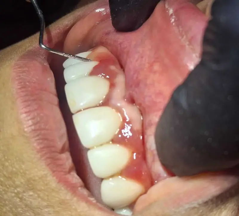 Imagen de un procedimiento de periodoncia