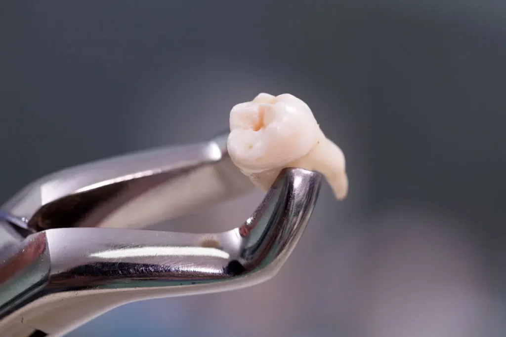 Qué es más doloroso una endodoncia o una extracción