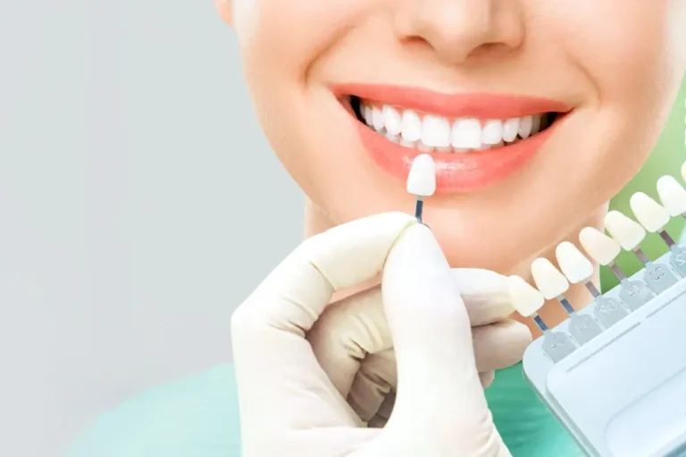Qué tan buenas son las carillas dentales
