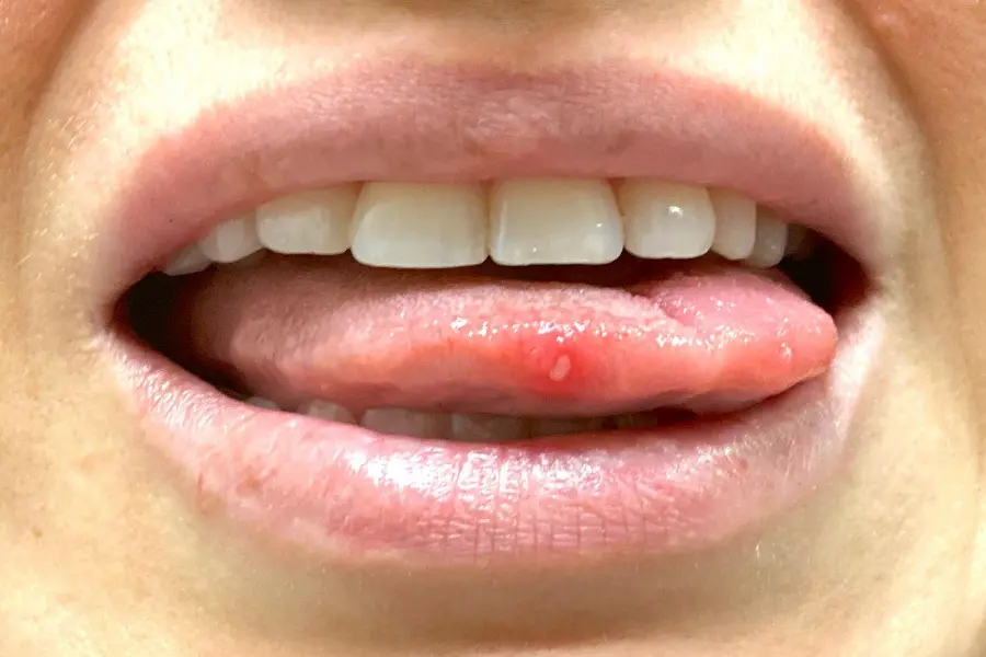 Cuánto tiempo dura un afta en la boca y cuándo consultar