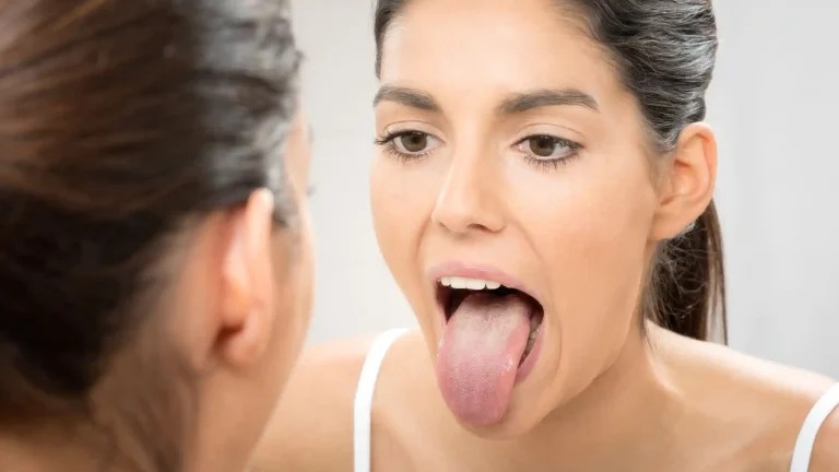 Es normal tener la lengua blanca