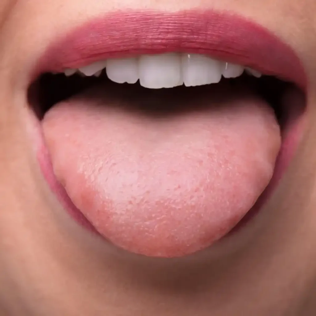 Lengua blanca ¿cómo se quita de forma efectiva