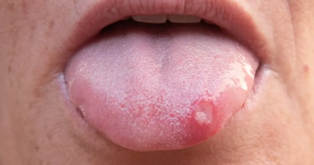 Por qué salen los afta en la boca