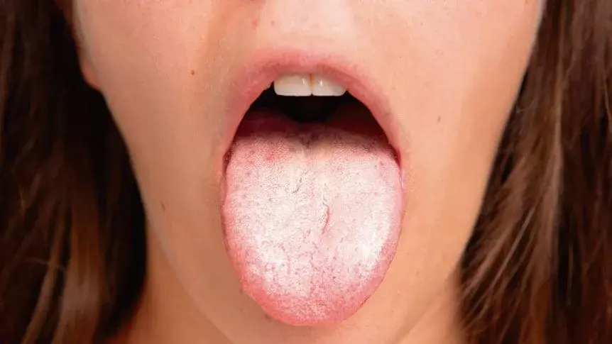 Principales causas de la lengua blanca