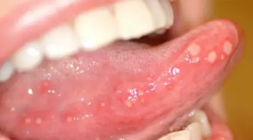 Principales causas ¿por qué salen los afta en la boca