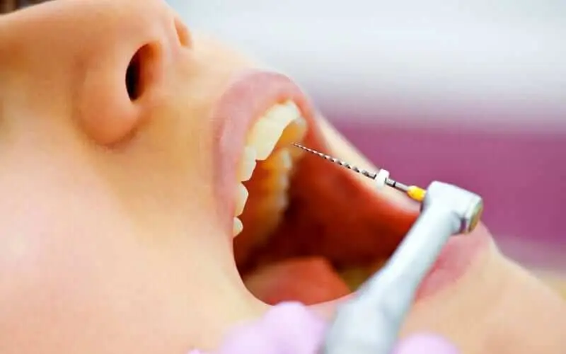 ¿Dolor de muela intenso Solución rápida con endodoncia en Lima