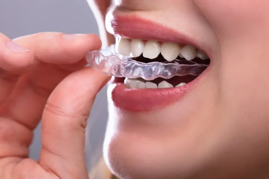 Tratamiento de bruxismo en Lima para aliviar el dolor y proteger tus dientes