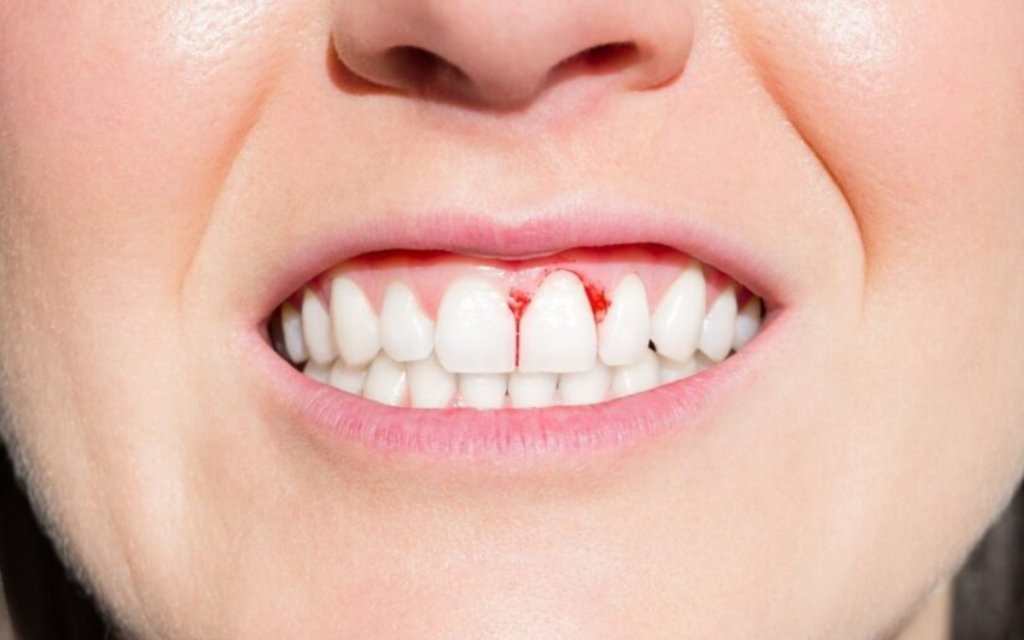 Encías que sangran al cepillarte o usar hilo dental