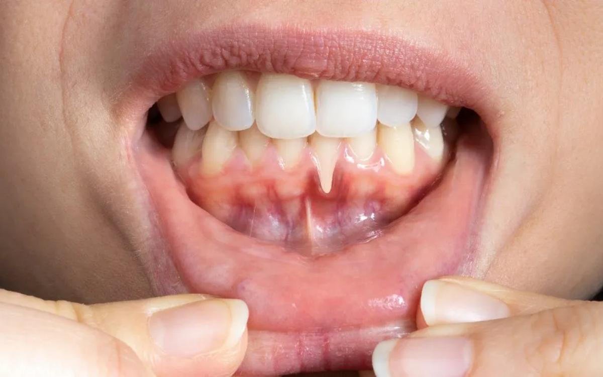 Encías retraídas o dientes que parecen más largos