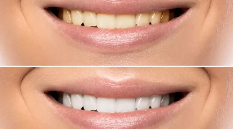 Se pueden blanquear los dientes amarillos