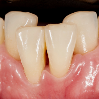Apiñamiento dental