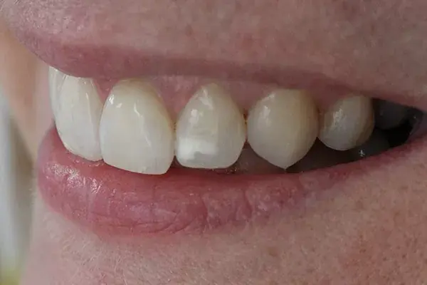 como quitar manchas blancas en los dientes