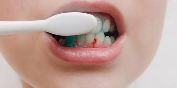 cuando me cepillo los dientes me sale sangre