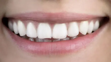 Armonización de la sonrisa