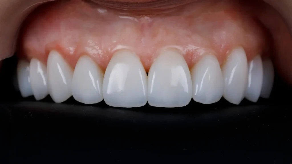 Carillas dentales