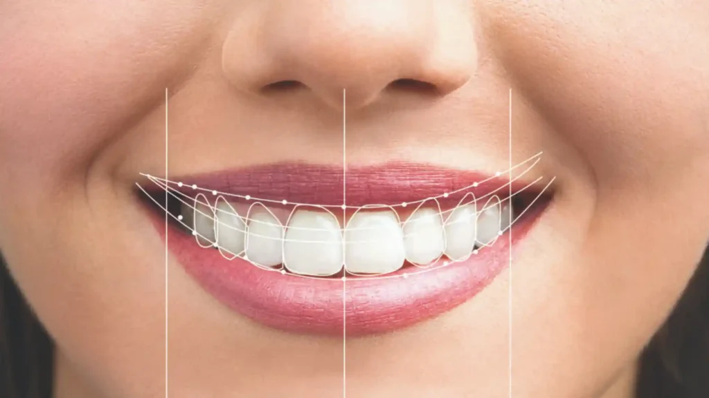 Diseño de sonrisa