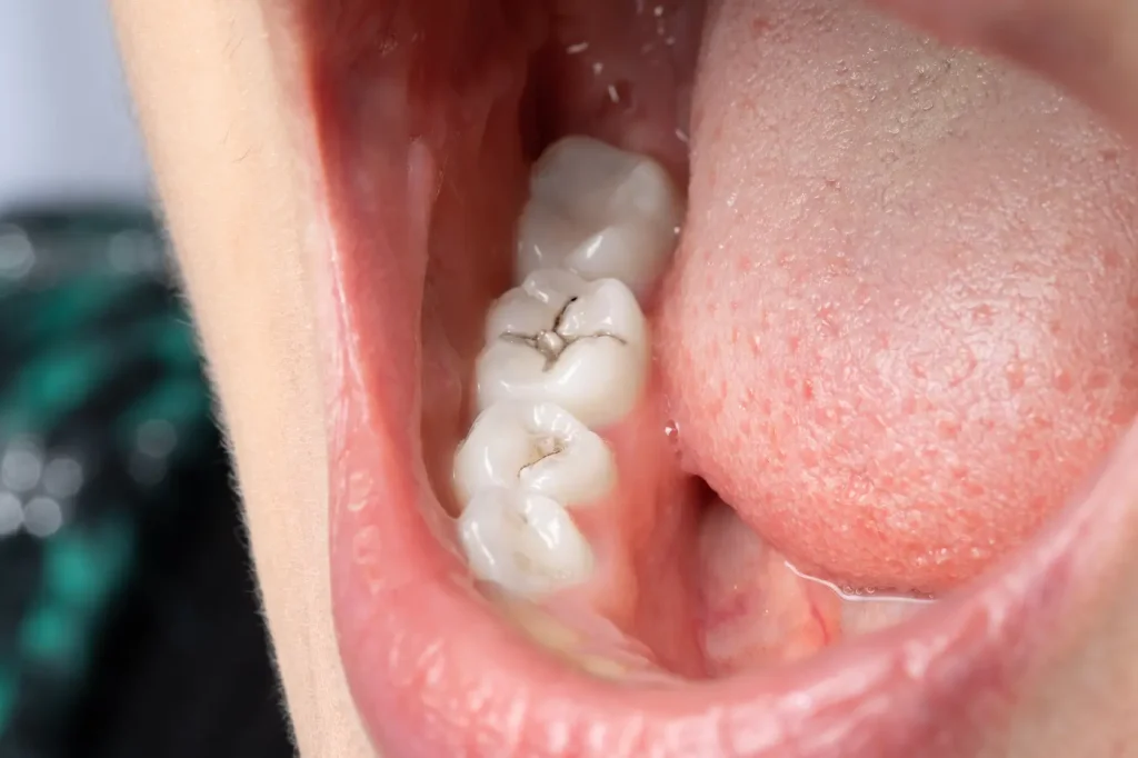 caries profunda