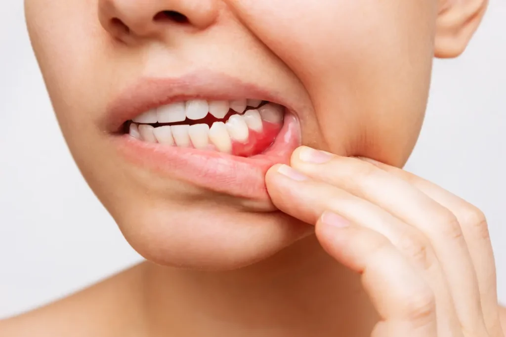 encías inflamadas