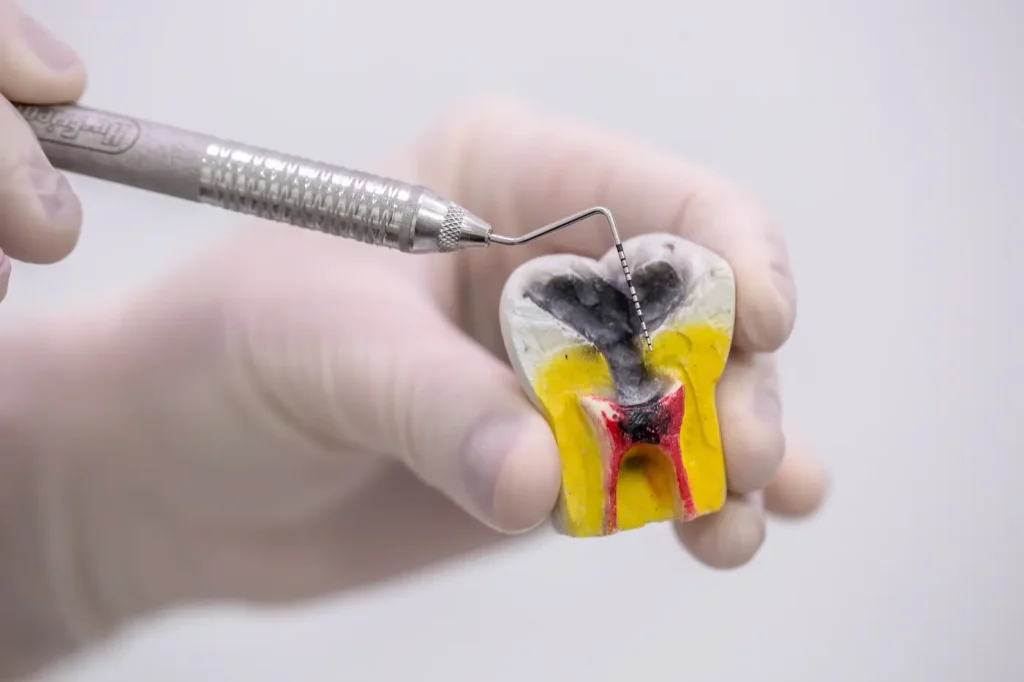 maqueta de un diente afectado por caries