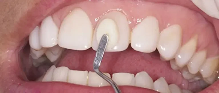 Tipos de resina dental