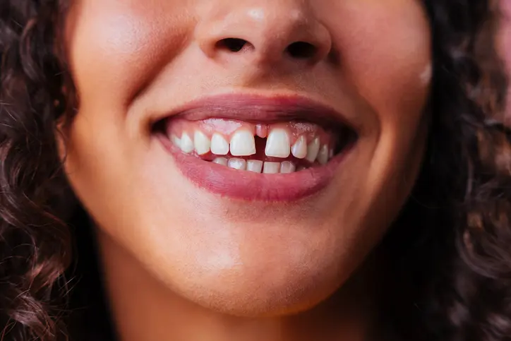 dientes separados