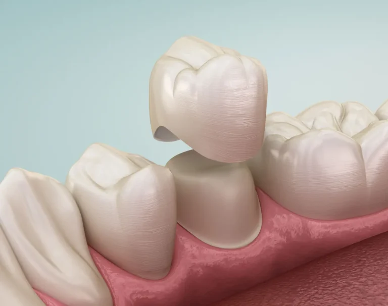 coronas de zirconio