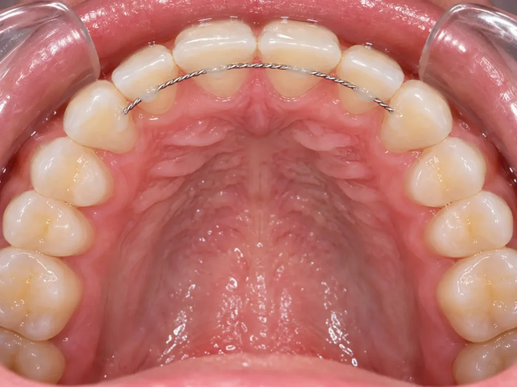 dientes con retenedores en la parte posterior