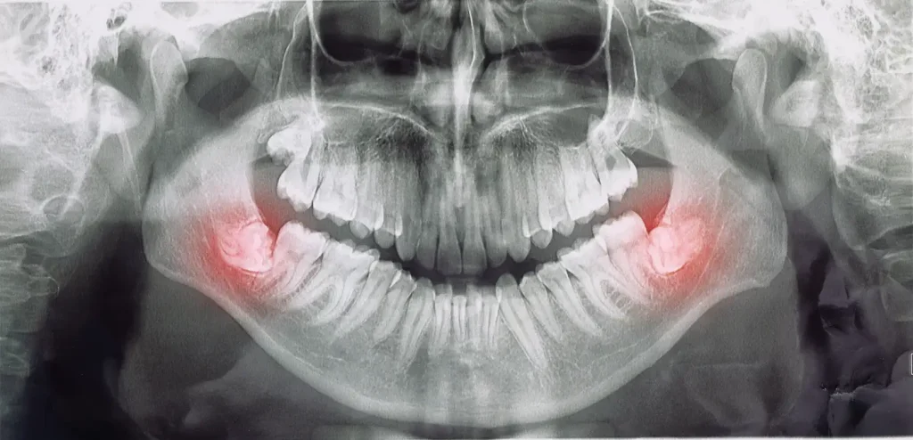 radiografía de unos dientes