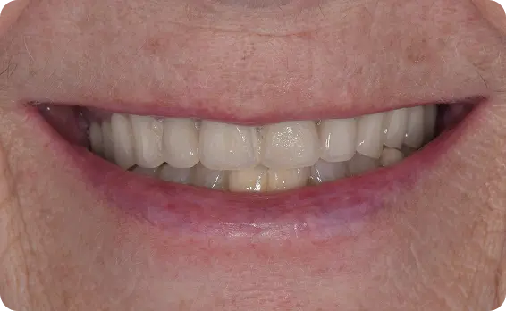 Antes del tratamiento dental