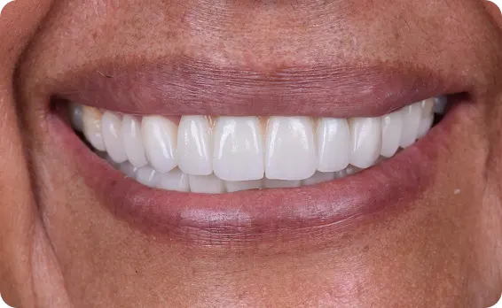 Resultado después del tratamiento dental