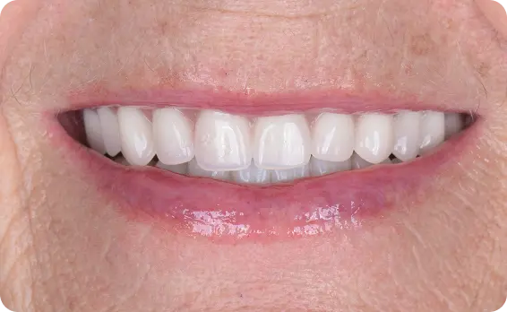 Resultado después del tratamiento dental