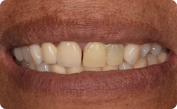 Antes del tratamiento dental